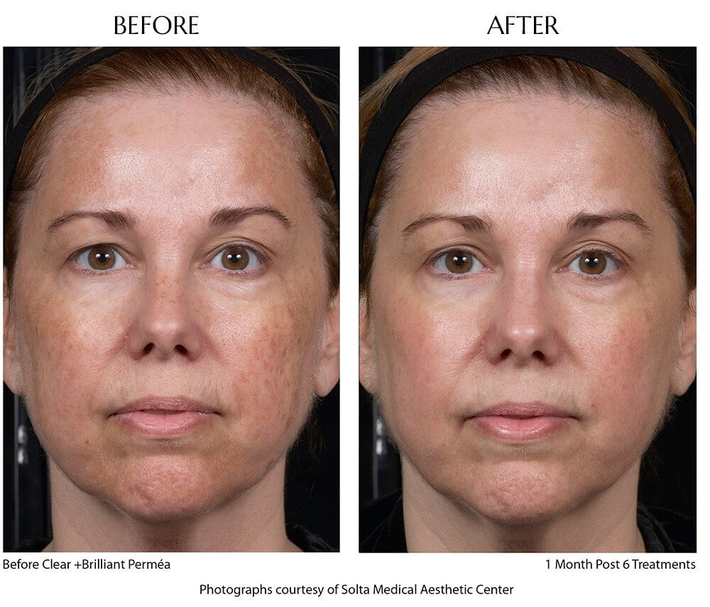 Dr. Jacobs offers Clear + Brilliant in NYC